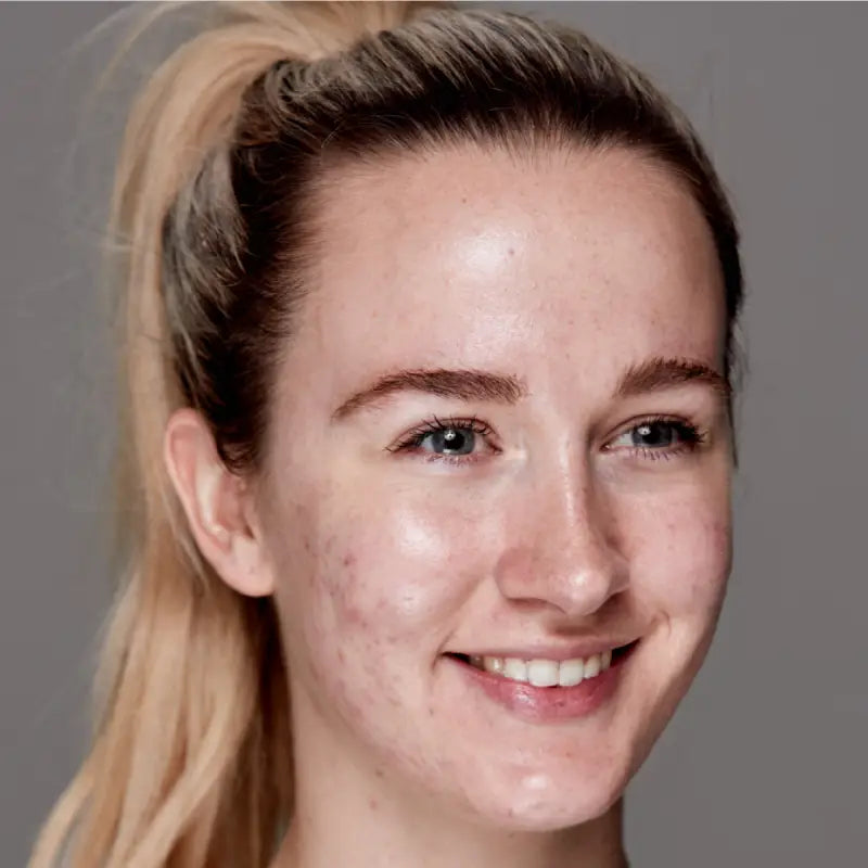 4 EFFECTIVE STEPS TO FIGHT ACNE