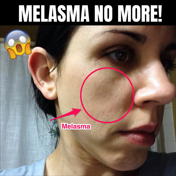 Anti-Melasma Lightening & Skin Perfecting Cream by Soo Yun™